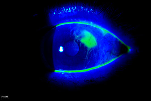(5) Corneal Abrasion with Foreign Body